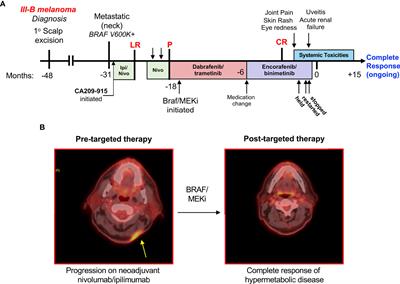 Case Report: Delayed Onset Multi-Organ Toxicities in a Melanoma Patient Achieving Complete Response to BRAF/MEK Inhibition